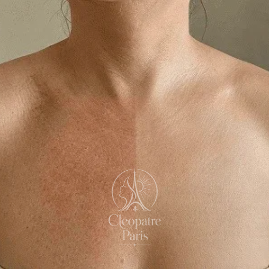Cou et decollete
